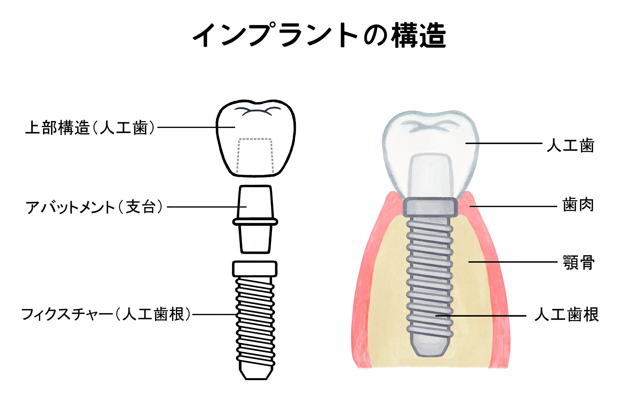 歯科インプラントの構造図